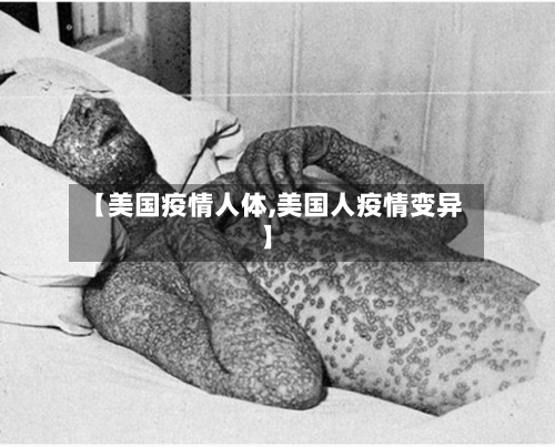 【美国疫情人体,美国人疫情变异】-第2张图片